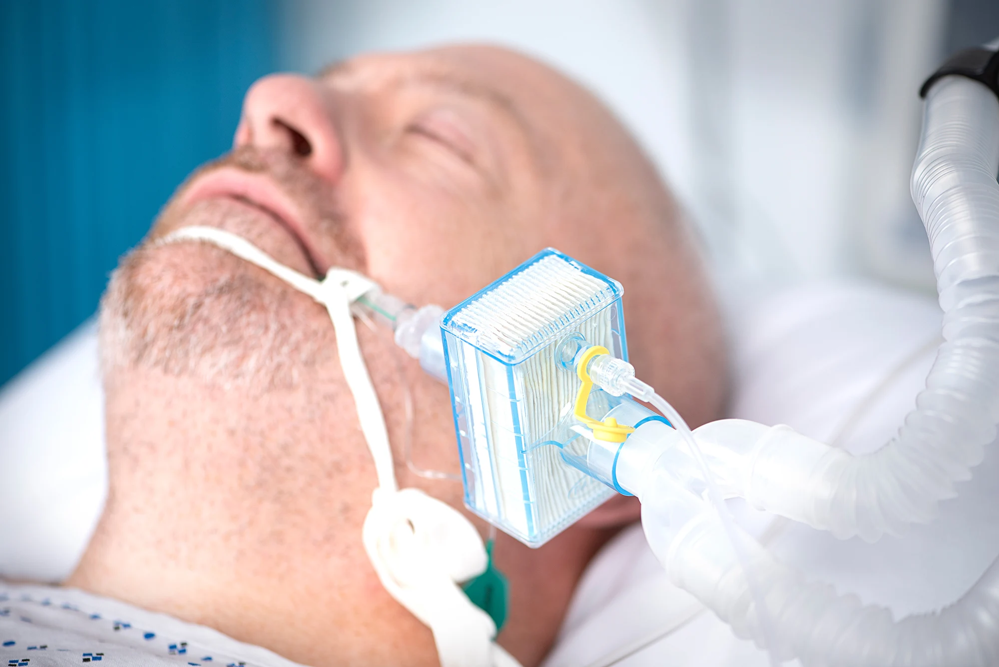 Close-up of a patient in a hospital bed with a ventilator tube connected to a Pall Medical breathing filter
