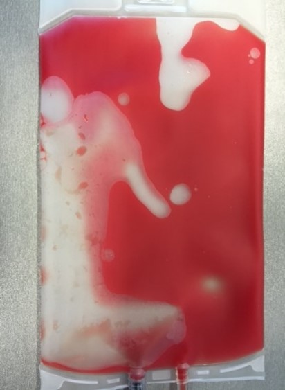 Final bag of MNC enrichment directly after RBC depletion with high platelet concentration