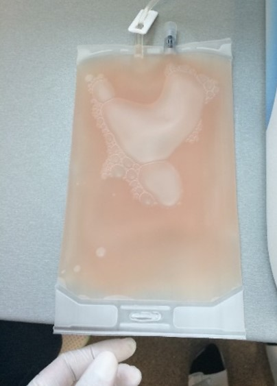 Final bag of MNC enrichment after paltelet removal followed by RBC depletion