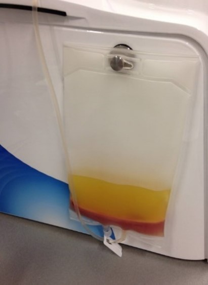 Intermediate bag of MNC enrichment directly after RBC depletion with high platelet concentration