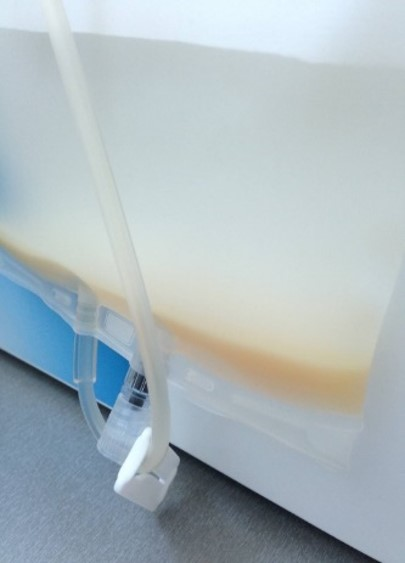 Intermediate bag of MNC enrichment after paltelet removal followed by RBC depletion