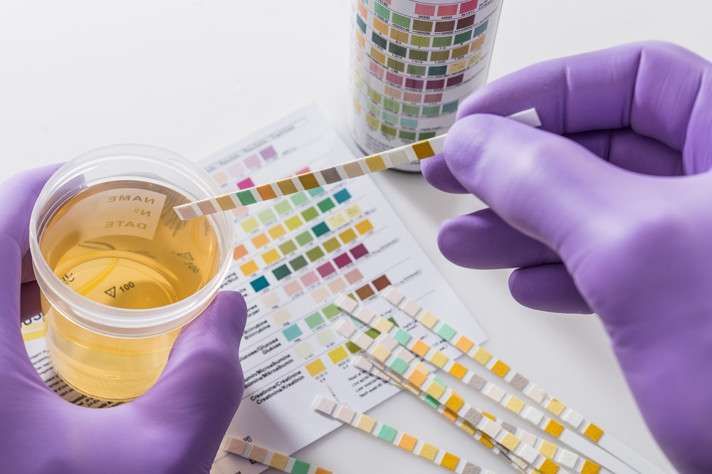 Urine analysis using dipsticks